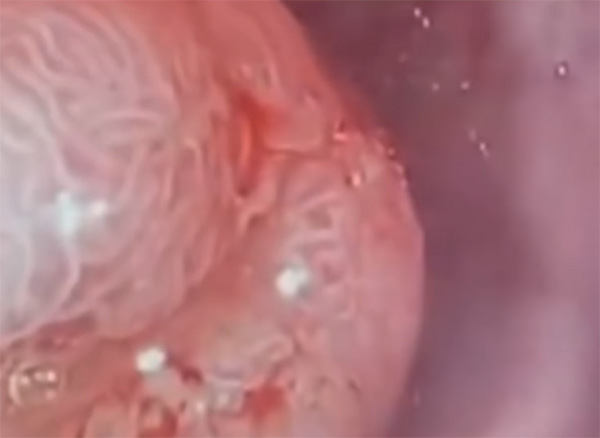 Parasites inside a colon cancer tumor